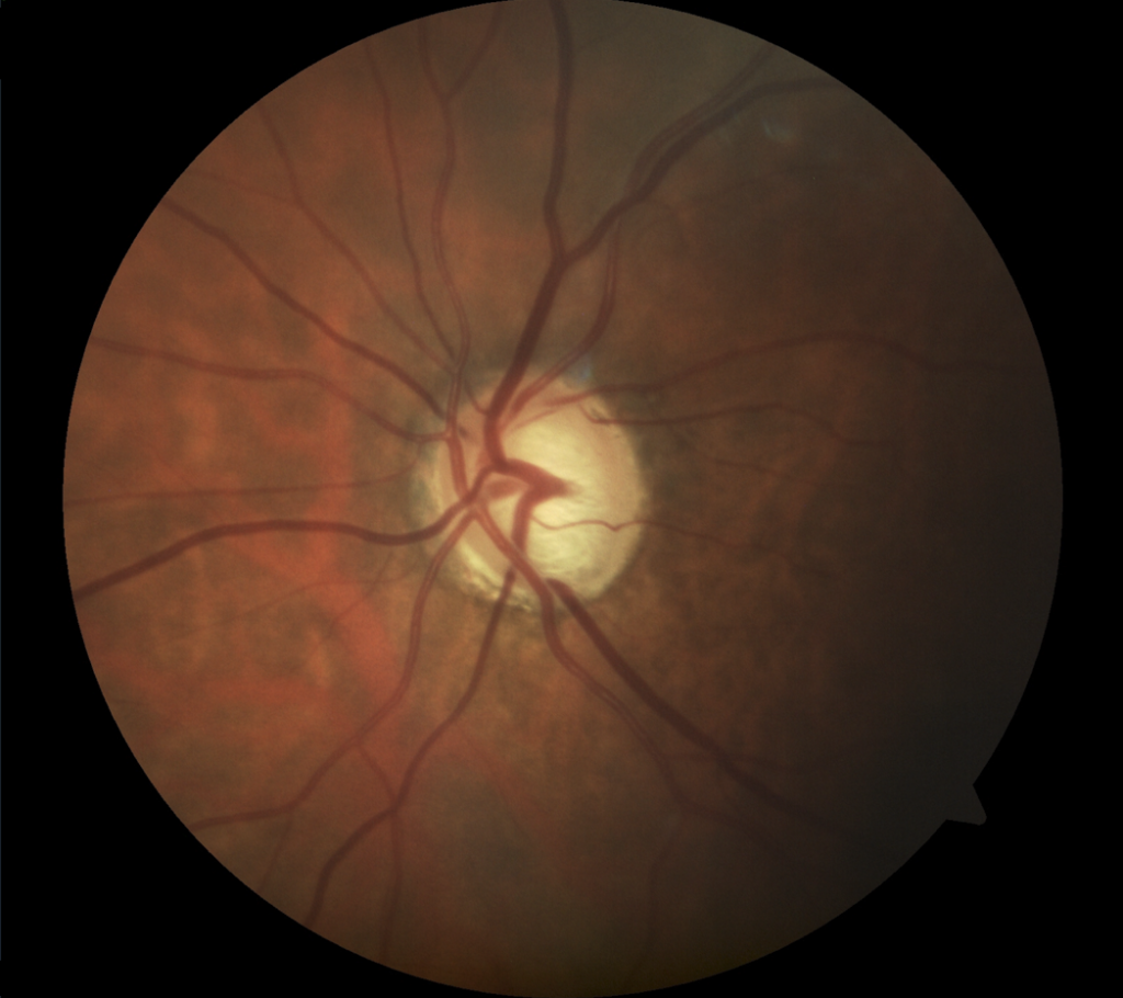 glaucoma